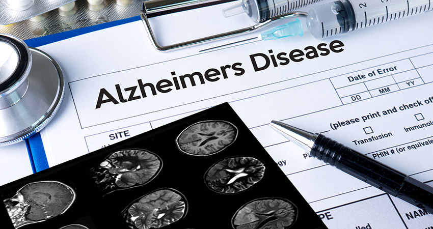Alzheimers Disease concept, Brain degenerative diseases Parkinson