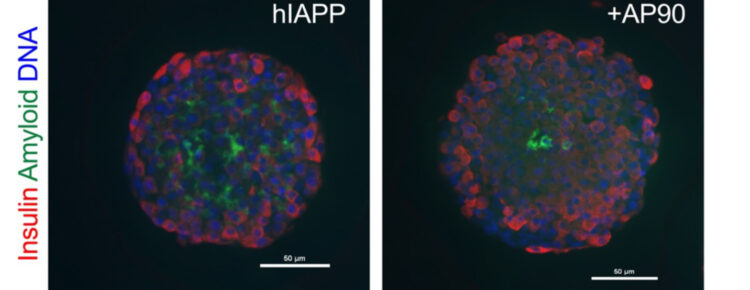 Microscopy image of beta cells making IAPP (left) and IAPP plus one of the team’s synthetic peptides (right).